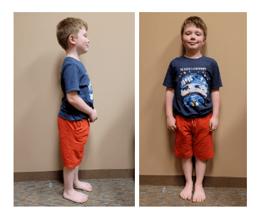 Serial casting what is it and when is it a good treatment option